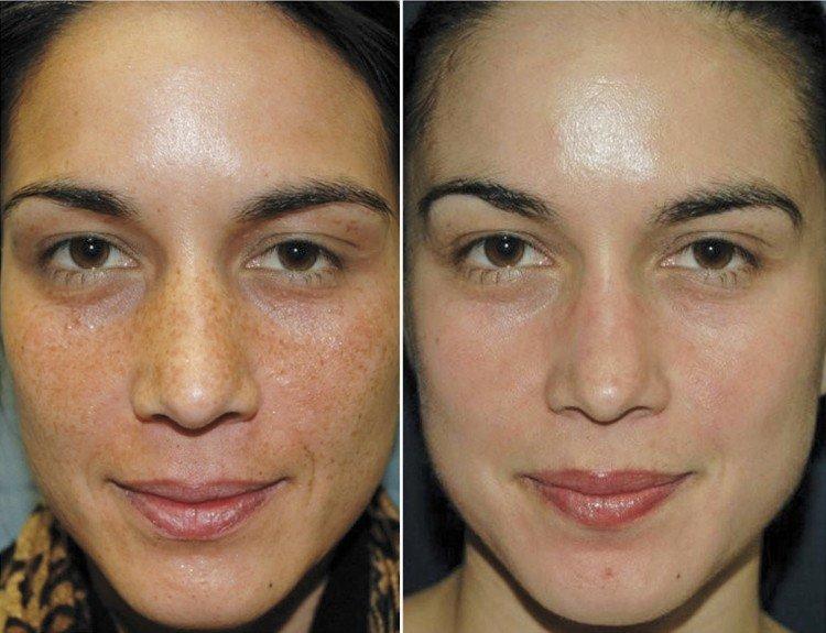 Что дает пилинг лица у косметолога фото до и после