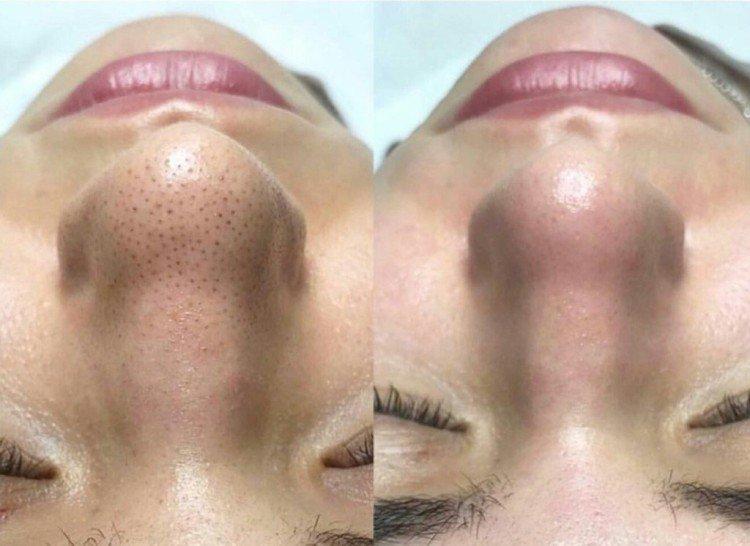 Ультразвуковая чистка лица - фото до и после