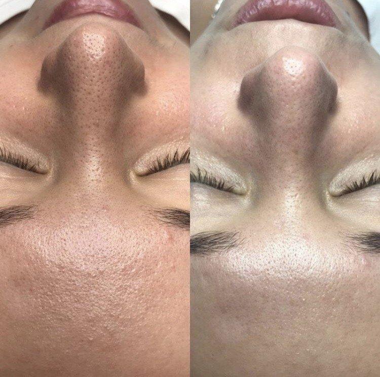 Ультразвуковая чистка лица - фото до и после