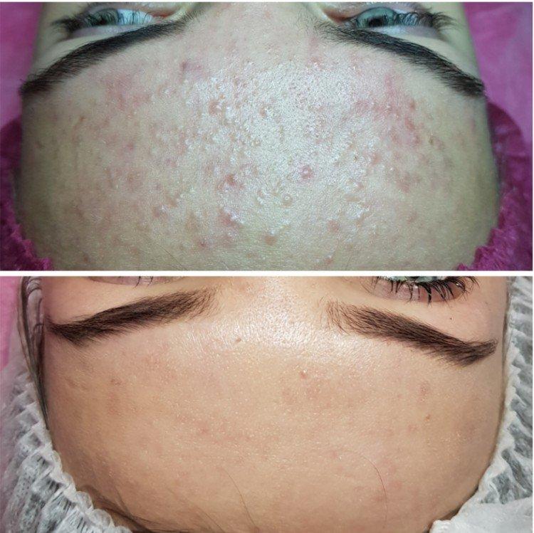 Химическая чистка лица у косметолога до и после фото
